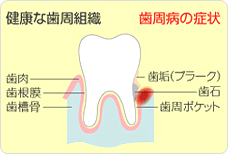 歯周病