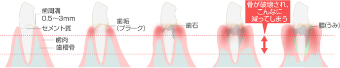 歯周病の進行